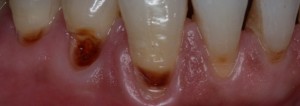 Cavities on Root Surfaces Before