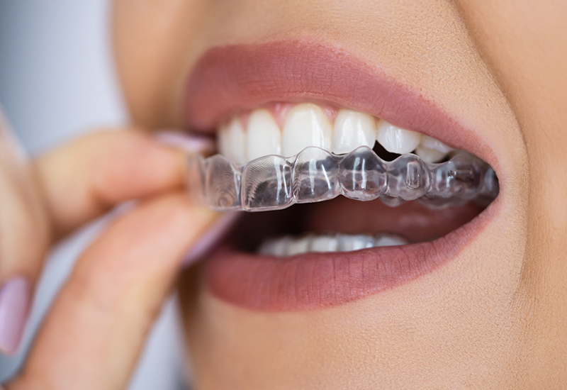 invisalign-uxbridge-family-dentistry